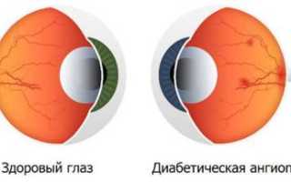 Ангиопатия сетчатки глаза: причины и симптомы