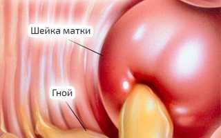 Восходящая гонорея: что это и почему возникает, как лечить.