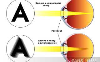 Методы лечения гиперметропического астигматизма