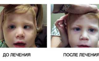 Симптомы и прогноз при амблиопии высокой степени