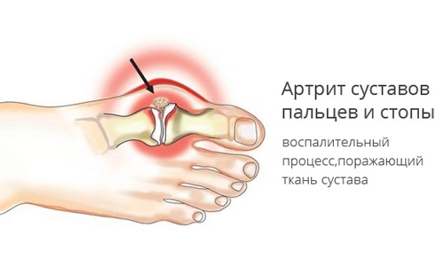 Артрит суставов пальцев и стопы 