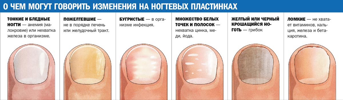Определение заболевания по ногтям