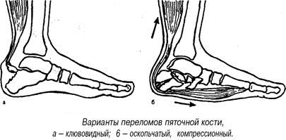 Виды переломов пятки