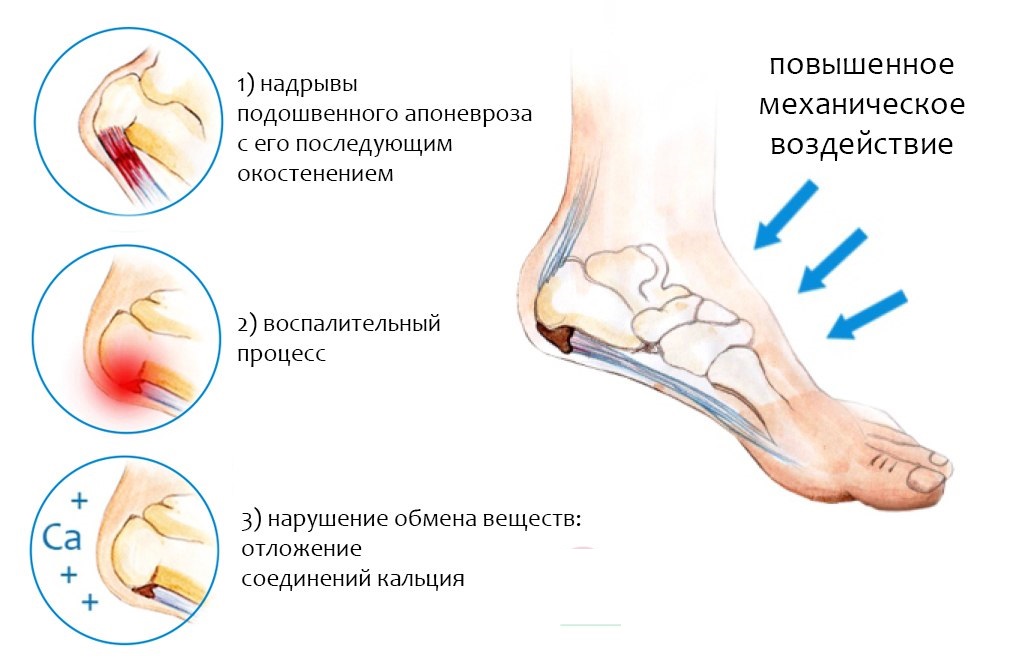 Возможные причины возникновения шпор на пятках