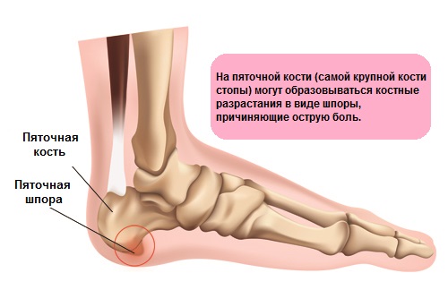 Пяточная шпора