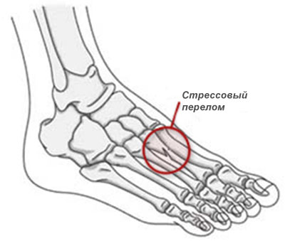 Стрессовый перелом стопы - причина болевого синдрома в кубовидной кости